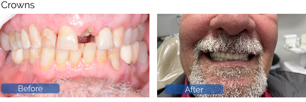 Crowns Before After - 2